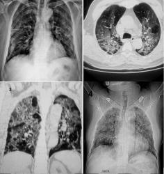 Khi nào nên kiểm tra phổi hậu Covid-19?